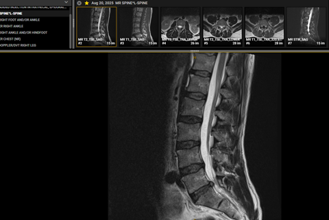 I've Experienced Disc-Related Sciatica Myself